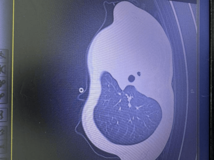 皇冠信用网正版
_发热一天就病危皇冠信用网正版
!11岁男孩肺里长出“死亡树杈”