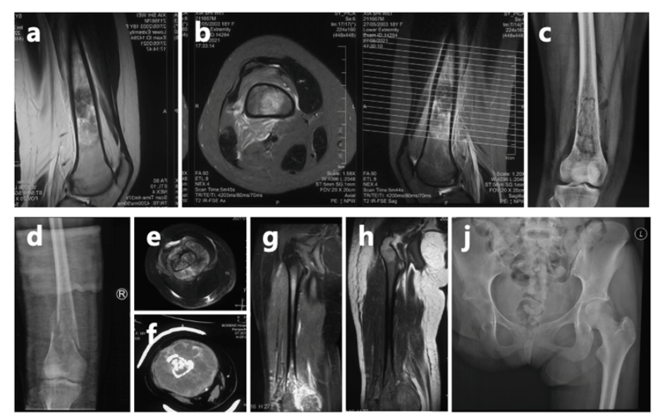 皇冠信用盘代理
_女孩高考晕倒确诊骨癌!自己签字进行6次手术截肢皇冠信用盘代理
,上海医生全力救治